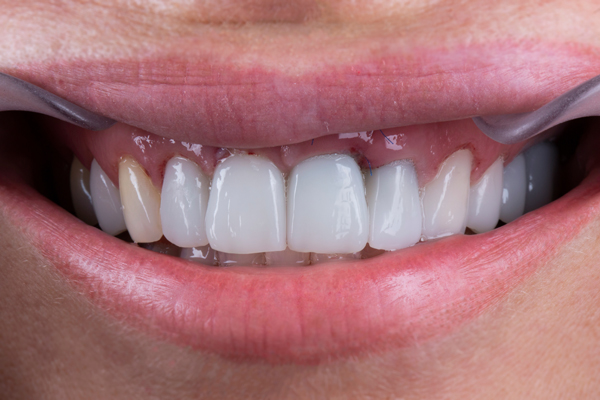 Five Questions To Ask A General Dentist About A Dental Implant Restoration