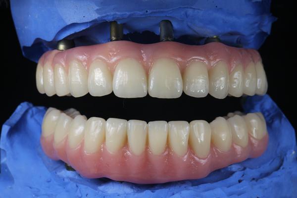 Why You Should Choose Implant Supported Dentures